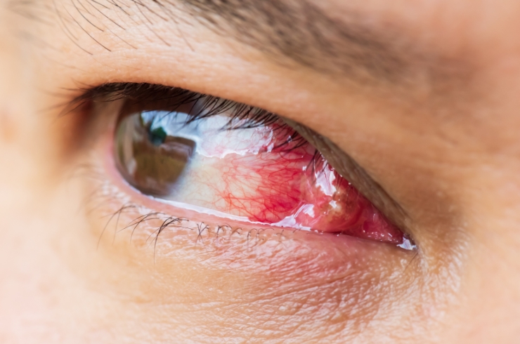 Pterygium S