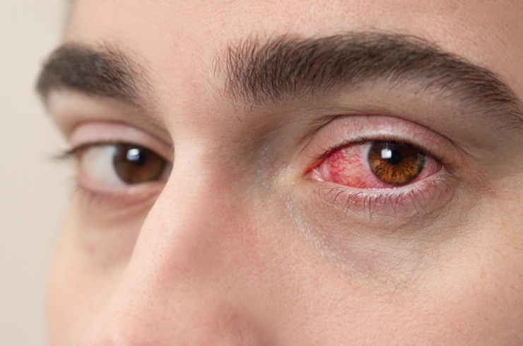 Uveitis